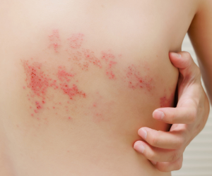Pediatric Skin Diseases